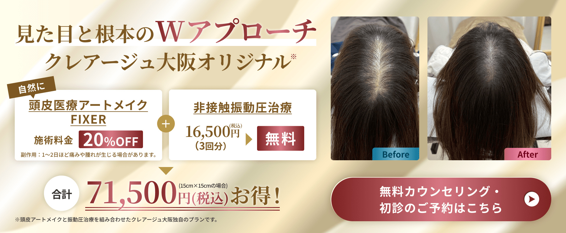 見た目と根本のWアプローチクレアージュ大阪オリジナル※ 自然に頭皮医療アートメイクFIXER施術料金20％OFF副作用：1～2日ほど痛みや腫れが生じる場合があります。＋非接触振動圧治療 16,500円(税込)（3回分）▶無料 合計16,500円(税込)お得！ ※頭皮アートメイクと振動圧治療を組み合わせたクレアージュ大阪独自のプランです。 無料カウンセリング・初診のご予約はこちら