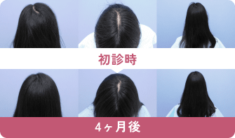 初診時と4ヶ月後の症例写真