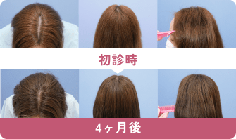 初診時と4ヶ月後の症例写真