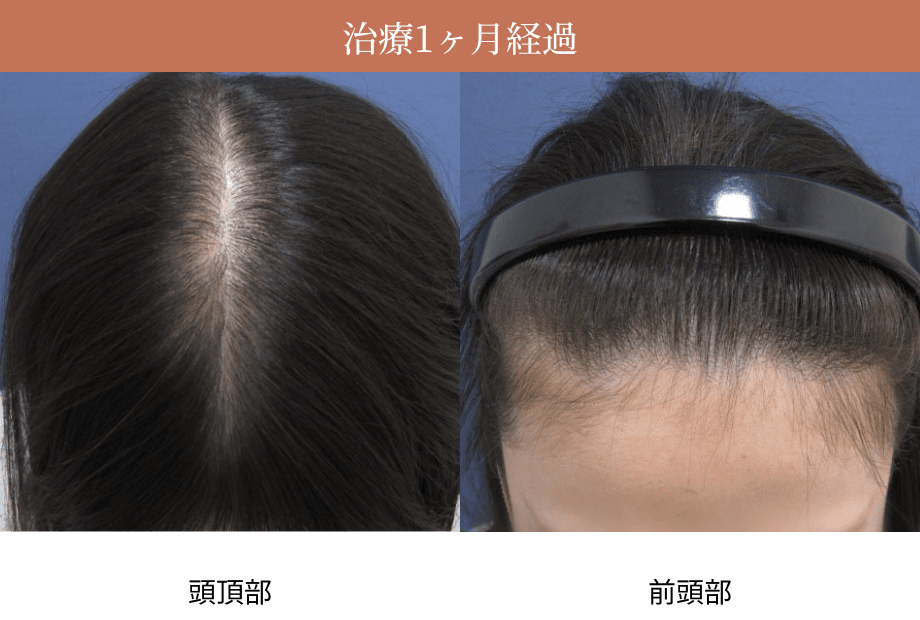 治療1ヶ月経過時の頭頂部・前頭部の画像