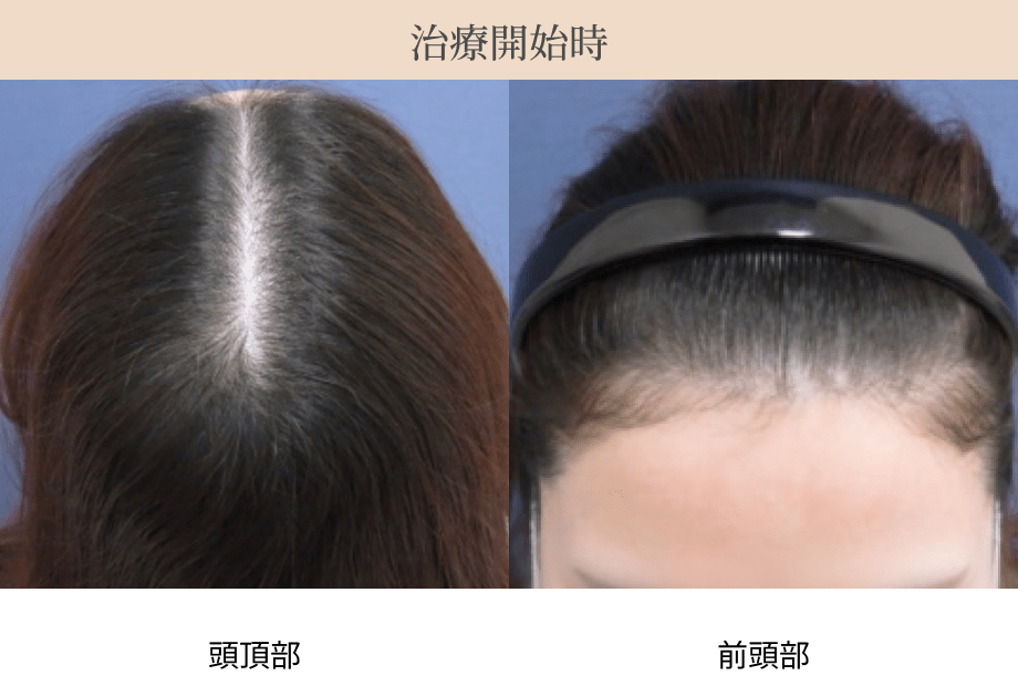 治療開始時の頭頂部・前頭部の画像