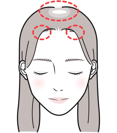 FAGA(女性男性型脱毛症) イメージイラスト