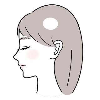 円形脱毛症 単発型 イメージイラスト