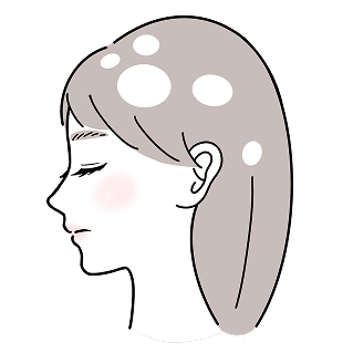 円形脱毛症 多発型 イメージイラスト