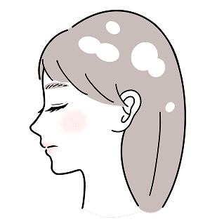 円形脱毛症 多発融合型 イメージイラスト