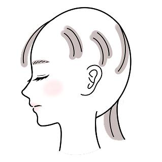 円形脱毛症 全頭型 イメージイラスト