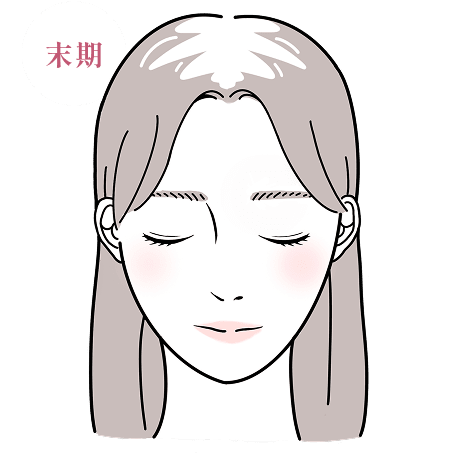 粃糠性脱毛症 イメージイラスト