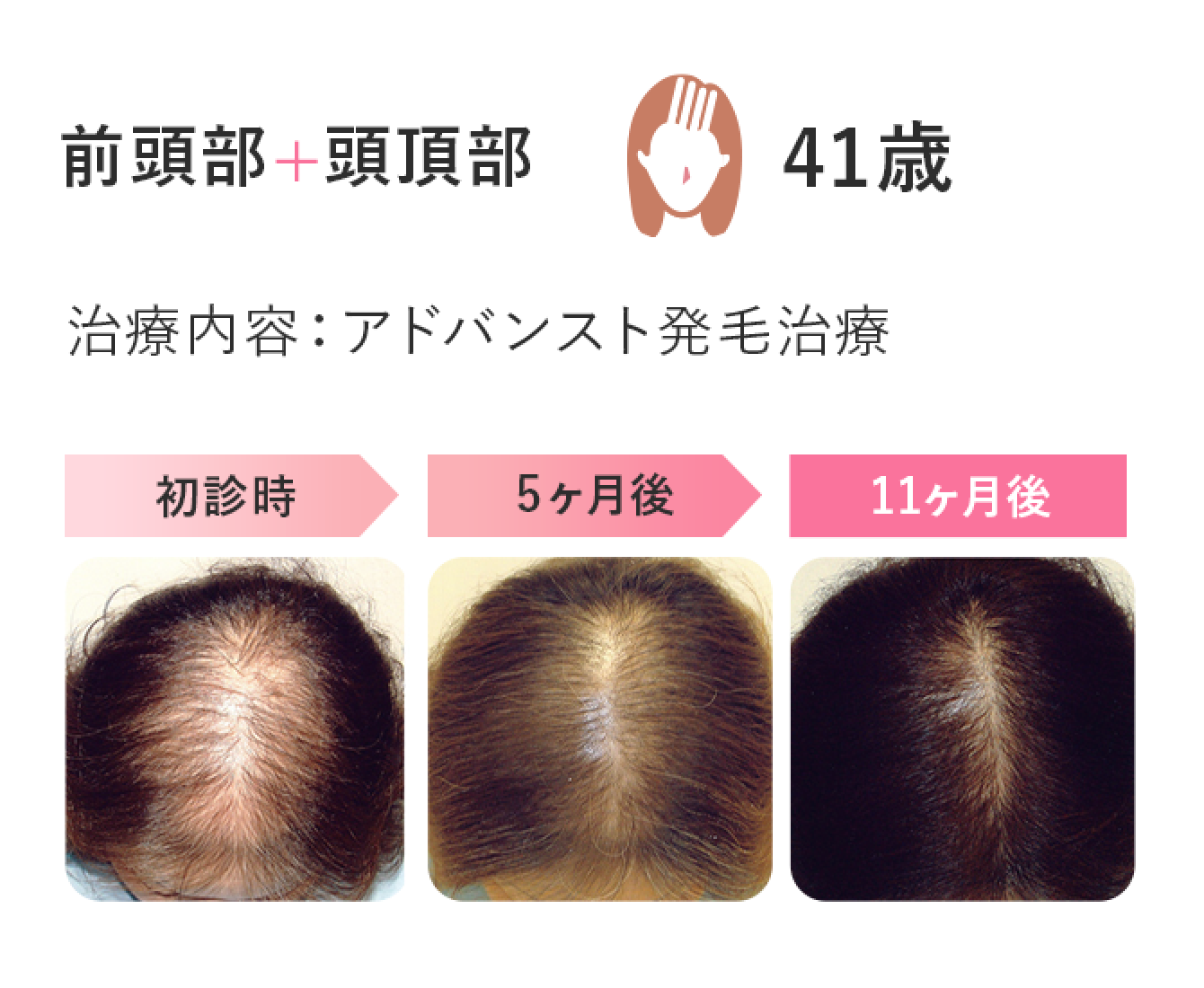 前頭部+頭頂部　41歳　治療内容：内服薬＋外用薬治療